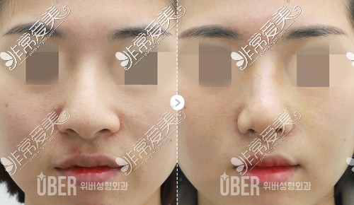 韩国玉芭无假体隆鼻前后对比图