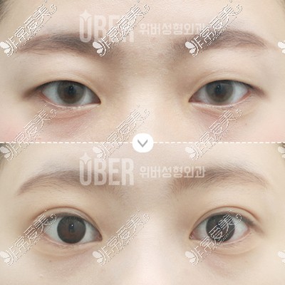 韩国玉芭uber整形医院超自然的双眼皮图片