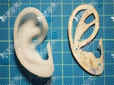 肋软骨耳与生物假体对比