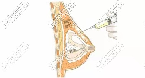 脂肪隆胸后悔了