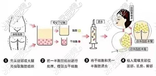 脂肪隆胸后悔了!胸部一天天长大还一直涨涨的感觉后悔死了!