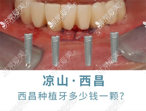 西昌種植牙價格圖