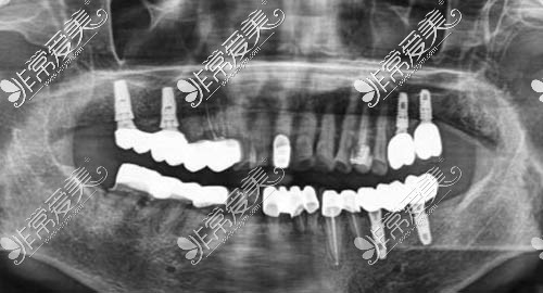 多颗牙修复手术图片