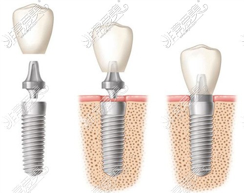 种植牙示意图