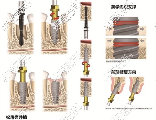 西昌牙博士口腔种植牙医生李仕强种植牙