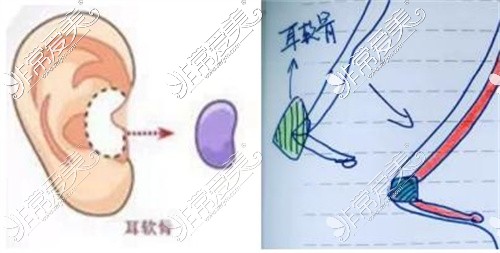 攀枝花奇丽整形美容耳软骨隆鼻示意图