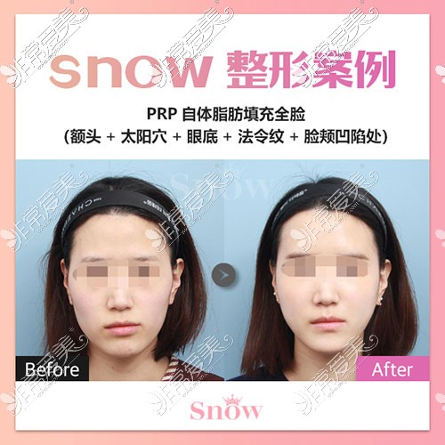 韩国snow面部脂肪填充图片