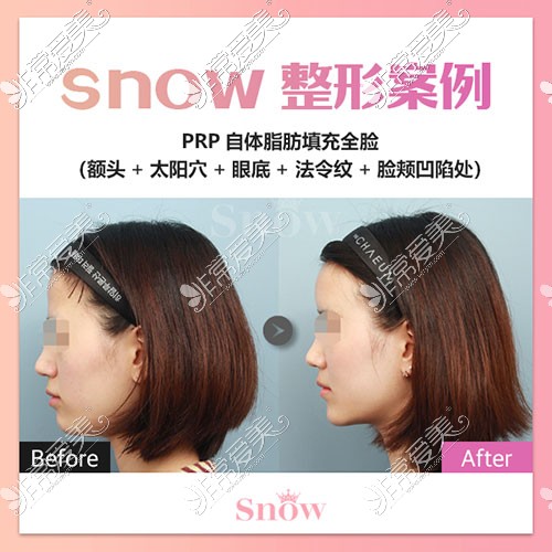 snow自體脂肪填充對比照