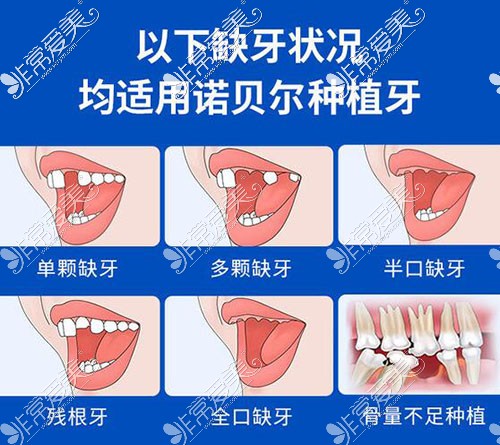 哪些牙齿需要进行种植改善