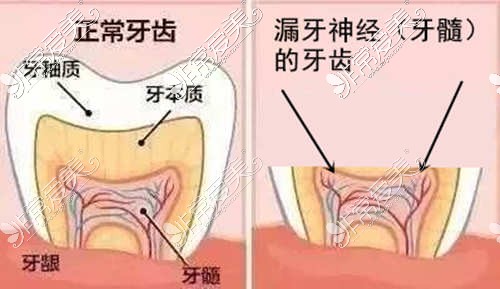 磨到漏神经的牙齿