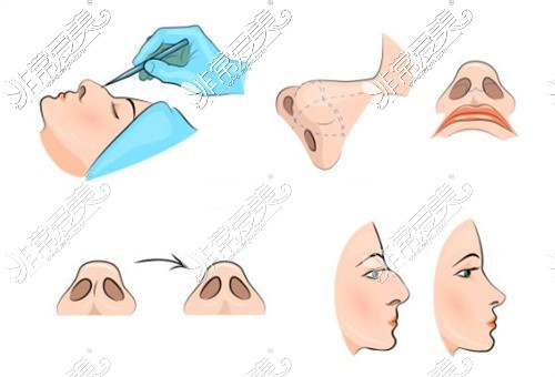 贵州贵阳利美康整形口腔医院隆鼻整形示意图