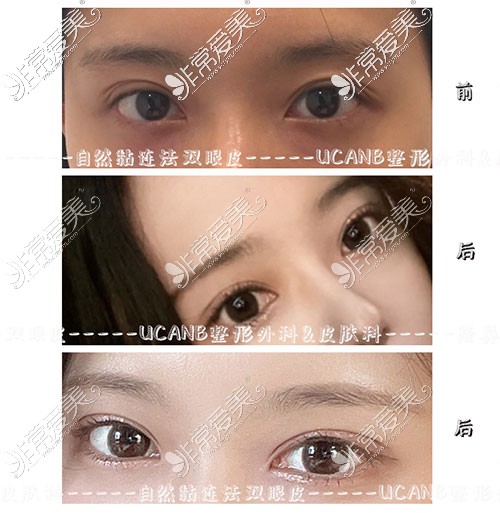 韩国Ucanb整形双眼皮手术对比照