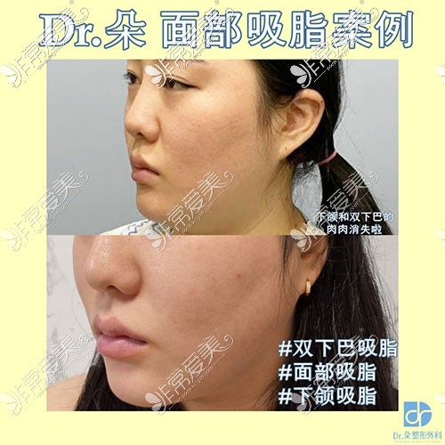 韩国dr朵面部吸脂图片