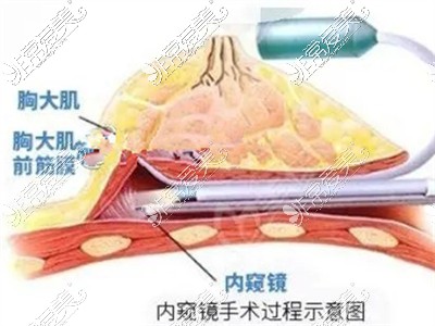 內(nèi)窺鏡植入假體示意圖