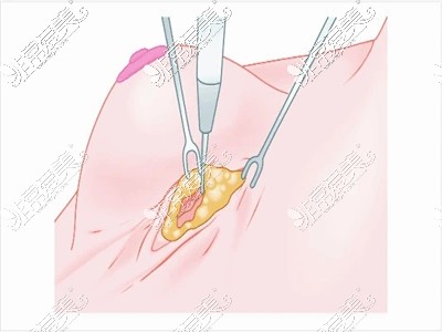 乳沟切口植入假体