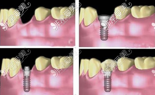 种植牙步骤图
