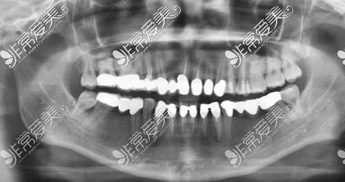 牙齒治療后ct照