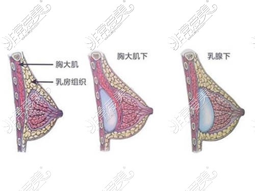 假体丰胸植入位置