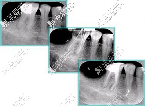 根管治疗前后对比图片