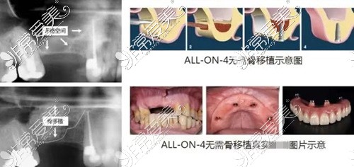 all-on-4种植牙技术示意图