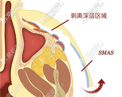 SMAS曾和深层剥离区域