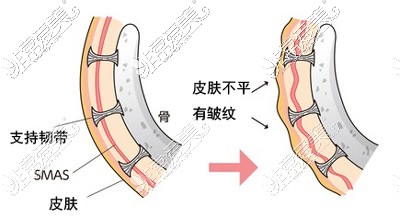 支持韧带和SMAS层