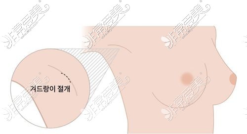 韩国原辰整形假体隆胸优势大起底,为何成为众多女性所追求!