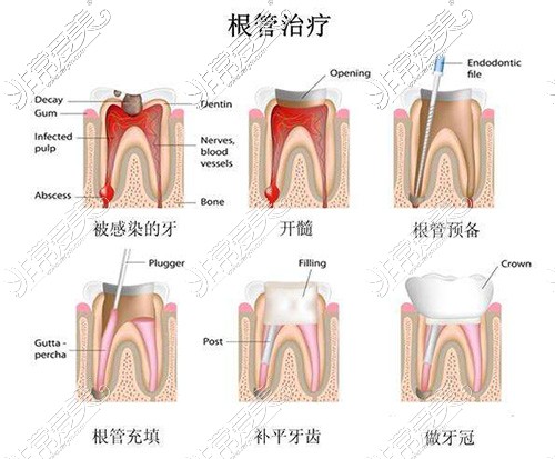 根管治療過程