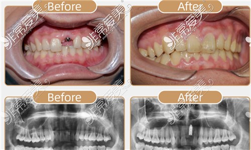 合肥佳冠口腔怎么样 正畸矫正和种植牙还可以这样便宜