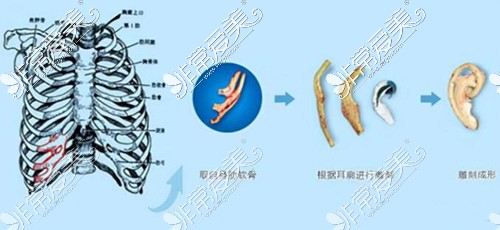 耳畸形改善治疗材料