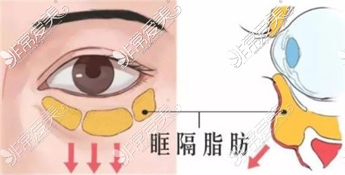 宜宾整形美容隔眶肌释放术