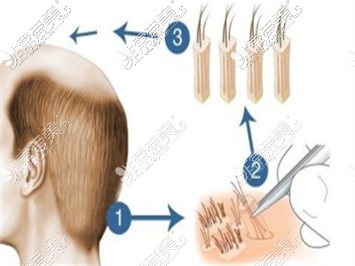 移植毛发过程