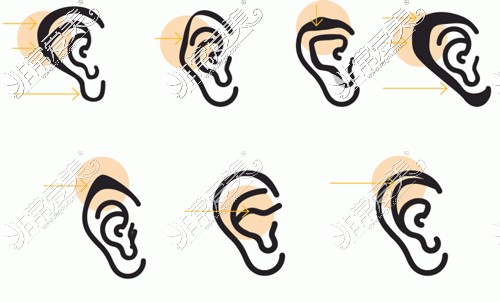 不同类型的耳畸形