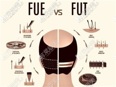 FUT植发技术与FUE植发技术对比