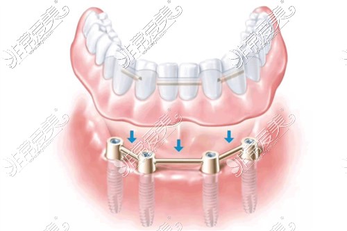 all-on-4种植牙示意图