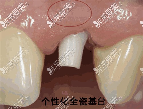 内江种植牙多少钱—颗?全新内江种植牙收费价格表标准曝光!