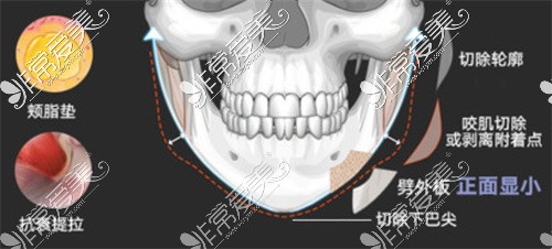 颌面轮廓三件套VLINE手术示意图