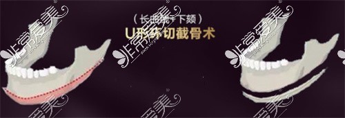 長曲線下頜角手術(shù)示意圖