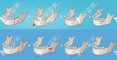 下颌骨改善治疗展示