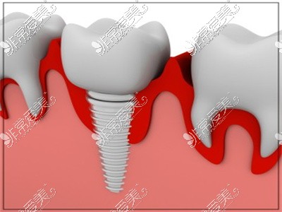 种植牙在牙龈内部对比