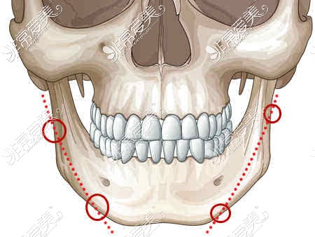 下颌角磨骨划线示意图