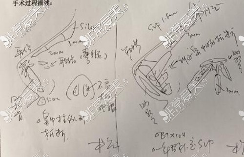 廣州徐士亮攣縮鼻改善手稿