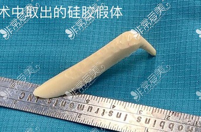 廣州徐士亮做的鼻子修復(fù)手術(shù)