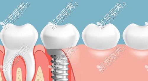 种植牙改善治疗材料图