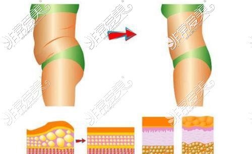 腰腹吸脂示意圖