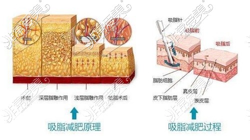 吸脂减肥原理示意图