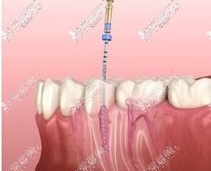 牙齿根管治疗图