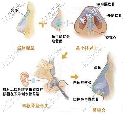 广州张明兴做的鼻子怎么样,是不是顾客认可隆鼻医生?