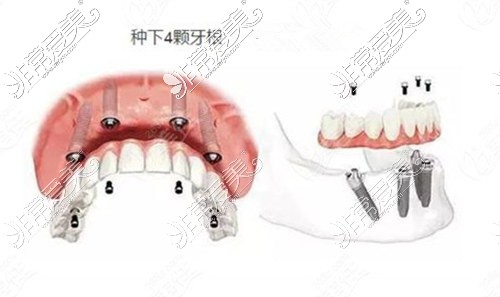 天津海德堡联合口腔医院网评公布，种植与矫正口碑都不错