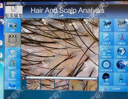 北京丽格植发毛发分析系统